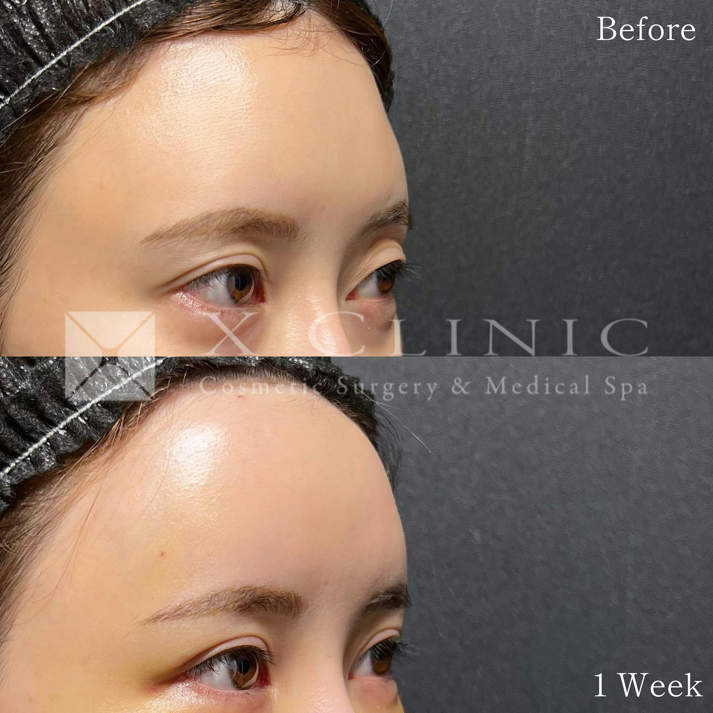 【女性・額】ベイビーおでこ＋PRP_before_aftar