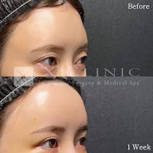 【女性・額】ベイビーおでこ+PRP_before_aftar