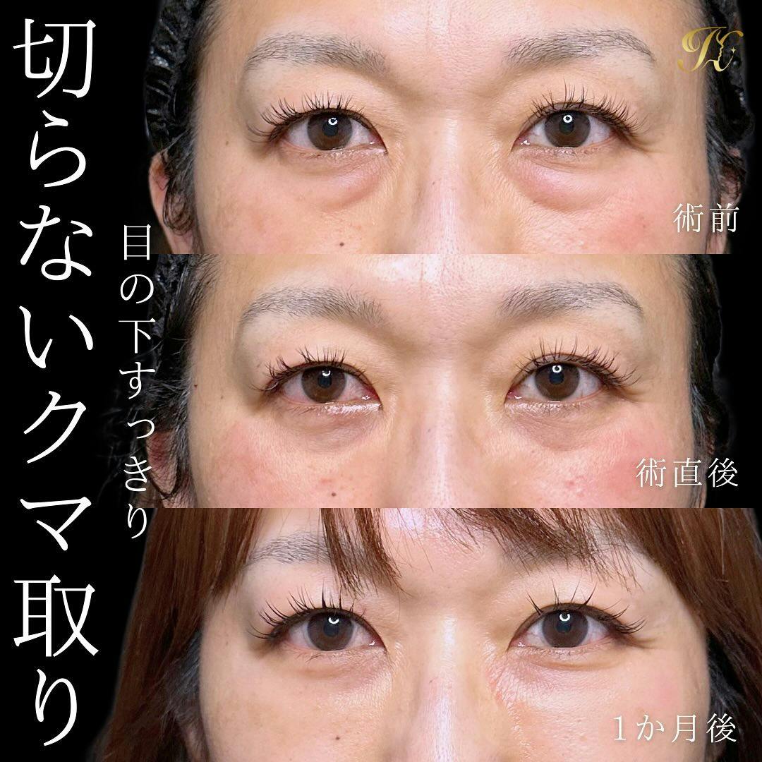 【女性・目元】切開法による⽬の下のたるみ取り（下眼瞼除皺術）_before_aftar