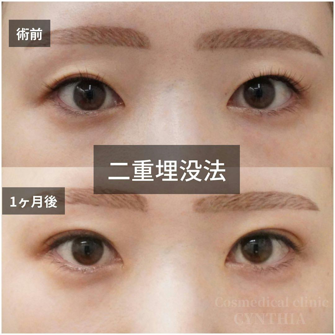 【20代女性・目元】二重埋没法_before_aftar
