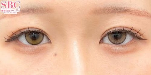 【20代女性・目元】クイックコスメティーク・ダブルNeo_after