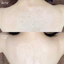 【女性・背中】ミラノリピールボディ_before_aftar