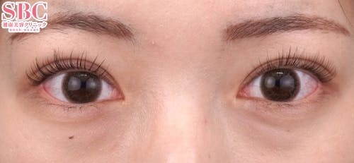 【20代女性・目元】クイックコスメティーク・トリプルNeo_1month