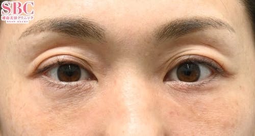 【女性・目元】裏ハムラ法、ナチュラル脂肪注射ナノリッチ_after