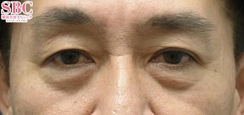 【男性・目元】目の下の切らないクマ・たるみ（ふくらみ）取り、ナチュラル脂肪注射コンデンスリッチ、ナチュラル脂肪注射ナノリッチ_before