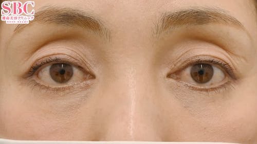 【40代女性・たるみ】アイバックリムーブ法 ナチュラル脂肪注射コンデンスリッチ ナチュラル脂肪注射ナノリッチ_after