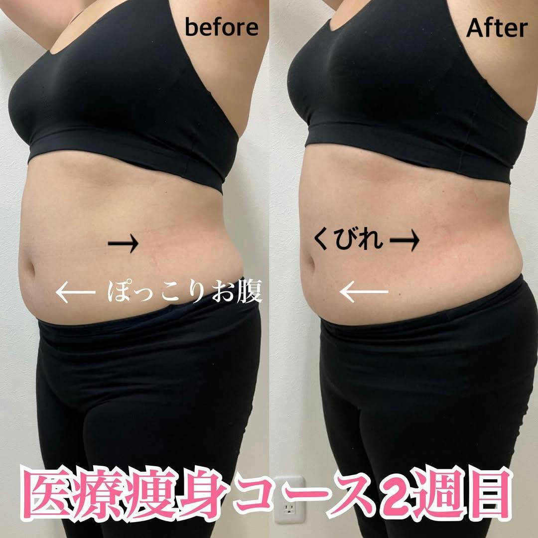 【女性・腹部】医療痩身スタンダードコース_before_aftar