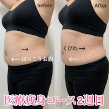 【女性・腹部】医療痩身スタンダードコース_before_aftar