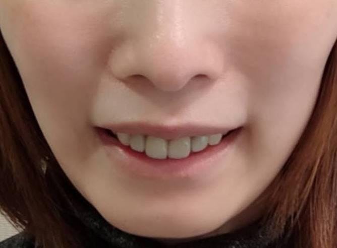 TCB東京中央美容外科 上野院で口元の整形：ガミースマイル治療（ボトックス注射）を受けたちゃもさんの写真