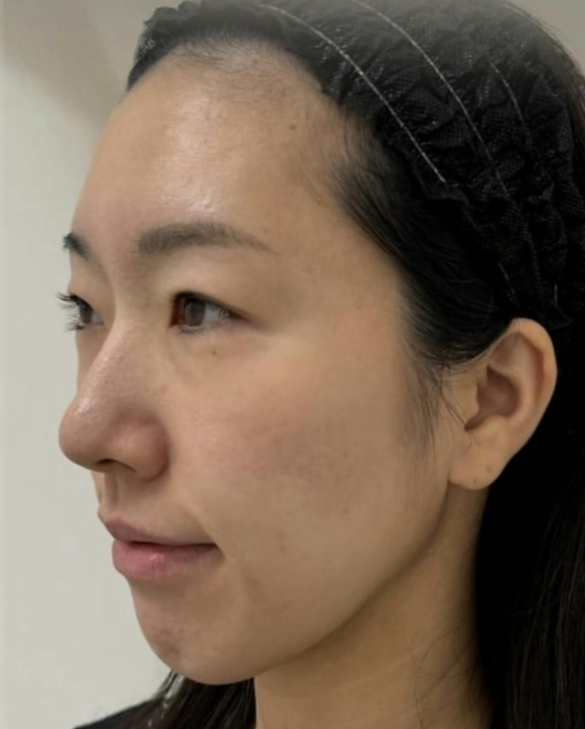 【30代女性・面長解消】ヒアルロン酸_b1