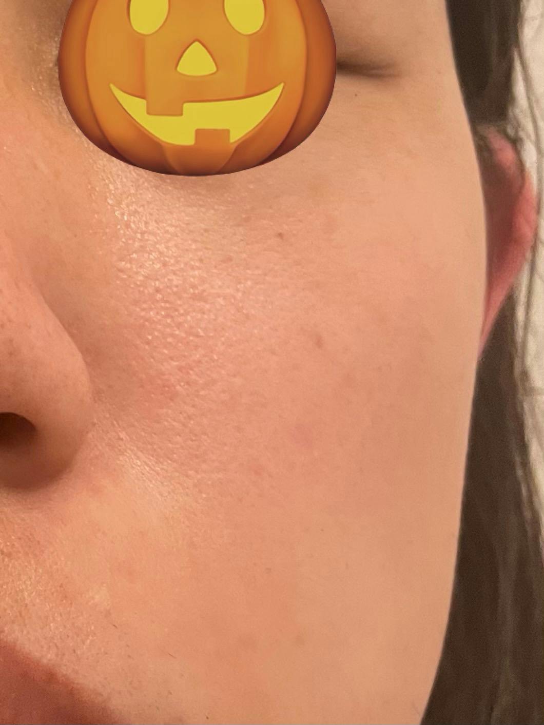 TCB東京中央美容外科 郡山院でほくろ・いぼ除去を受けたかぼさんの写真