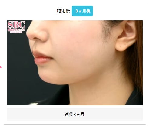 【女性・顔】根こそぎVASER脂肪吸引_aftar