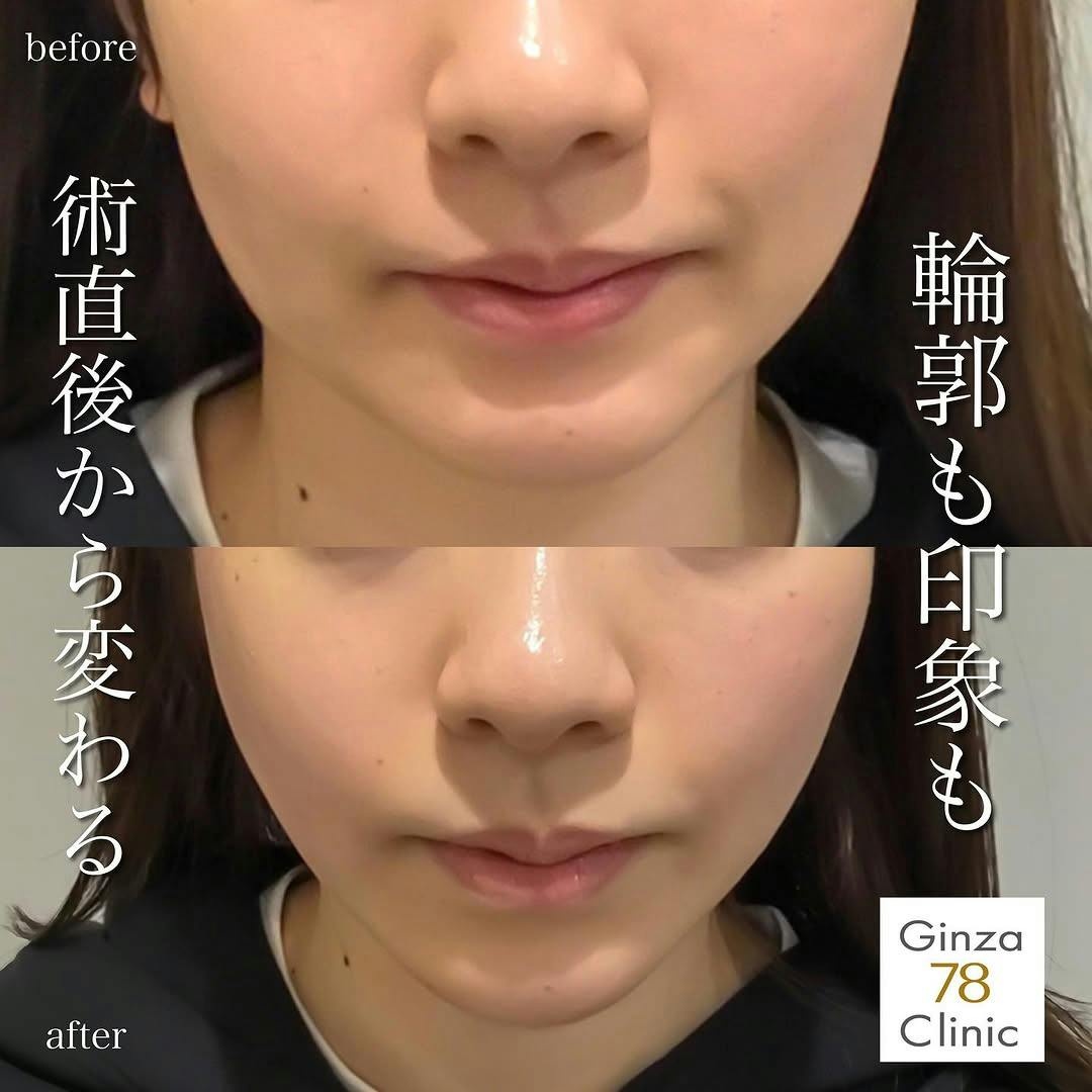 【女性・頬】ポテンツァのダイヤモンドチップ 78式ボ肌小顔リフト_before_aftar