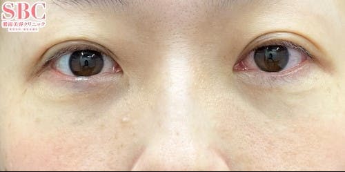 【女性・目元】目の下の切らないクマ・たるみ（ふくらみ）取り_after