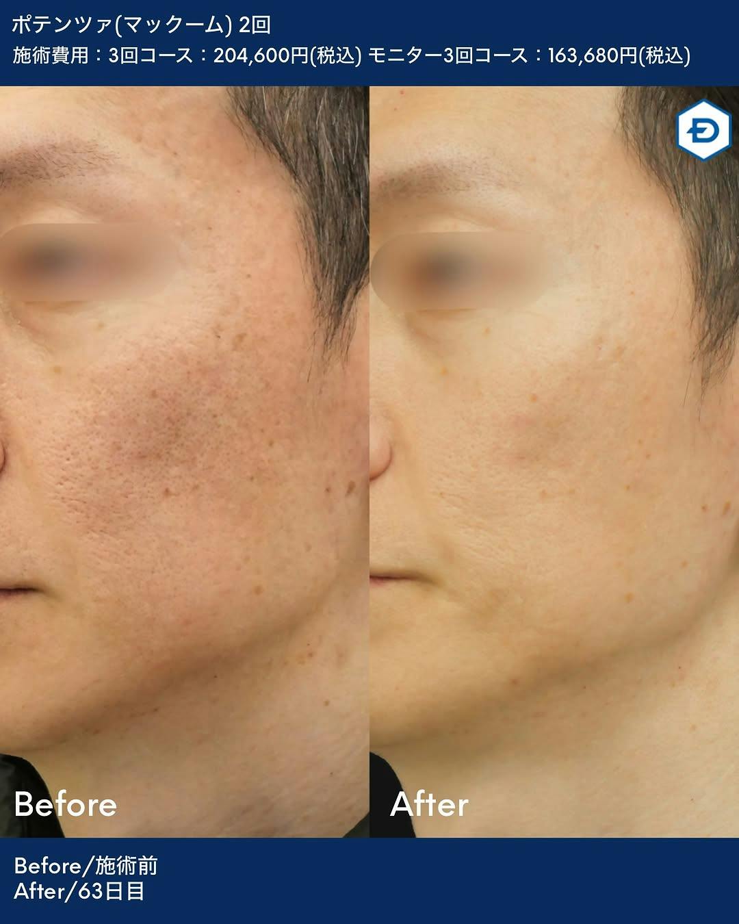 【男性・毛穴】ポテンツァ(マックーム)_before_aftar
