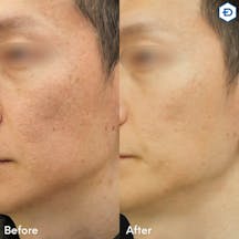 【男性・毛穴】ポテンツァ(マックーム)_before_aftar