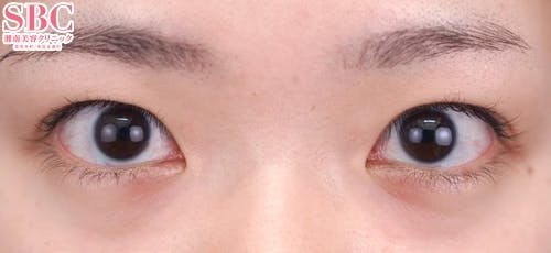 【20代女性・目元】ハイブリッド式二重術_before