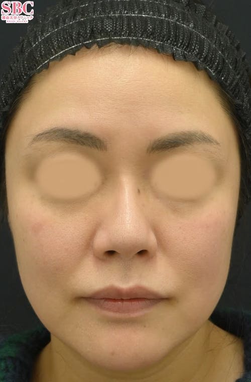 【女性・たるみ】女優注射(R)~リジュラン＋ボトックス~、プロファイロ_1month