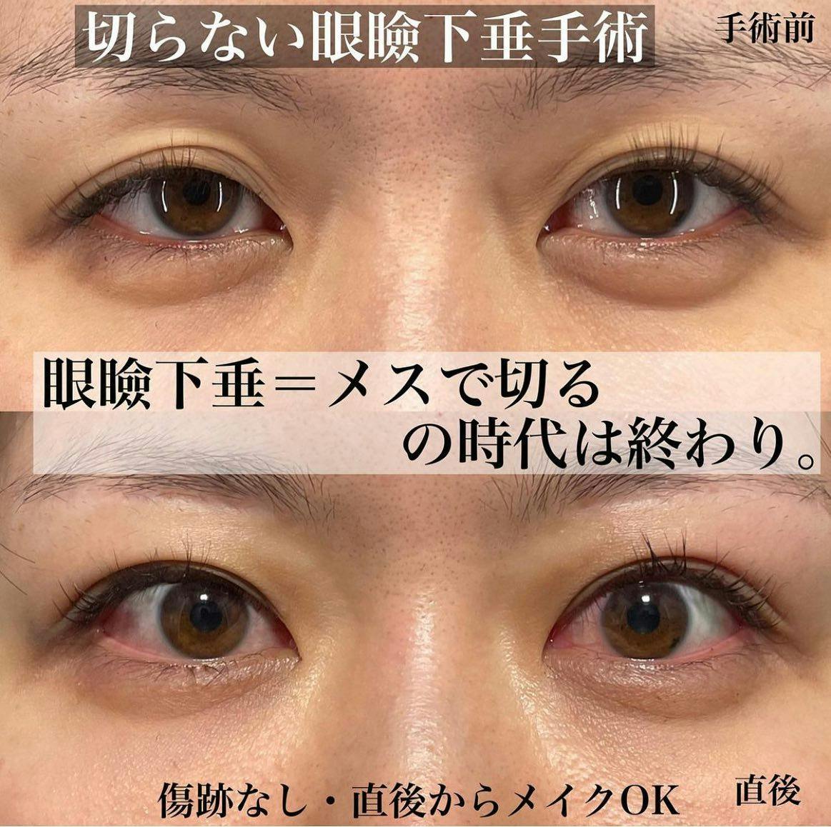【女性・目元】Xクロスダブル(両目) デカ目術(切らない眼瞼下垂術)_before_aftar