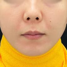 【女性・たるみ】プリマリフト、シークレットリフト_before