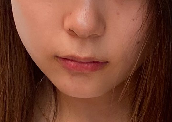 湘南美容クリニック 名古屋院で脂肪吸引・顎下の脂肪吸引・顔の脂肪吸引・輪郭・エラの脂肪吸引・ベイザー脂肪吸引・アキーセル脂肪吸引を受けたあいさんの写真