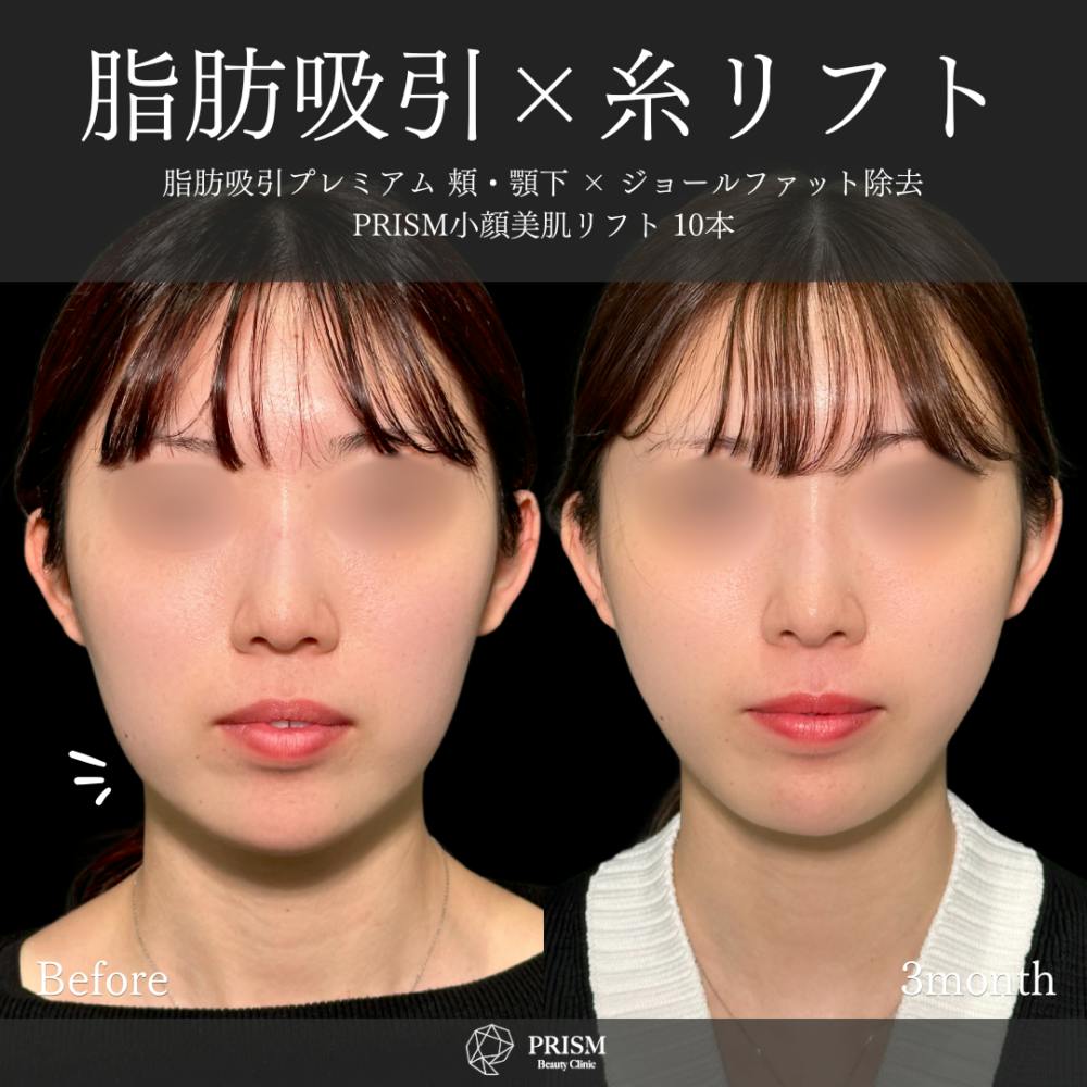 【20代女性・顔】脂肪吸引プレミアム（頬・顎下）＋ジョールファット除去＋糸リフト（ウルトラソフト）_before_aftar