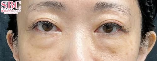 【40代女性・目元】目の下の切らないクマ・たるみ（ふくらみ）取り、ナチュラル脂肪注射コンデンスリッチ、ナチュラル脂肪注射ナノリッチ_before