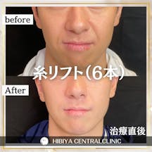 【男性・たるみ】糸リフト_before_aftar