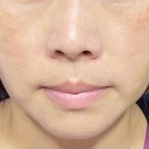 【女性・たるみ】テスリフト シークレットリフト_aftar