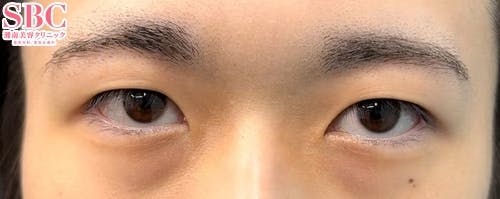 【20代男性・目元】週末二重(R)_before