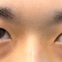 【20代男性・目元】週末二重(R)_before