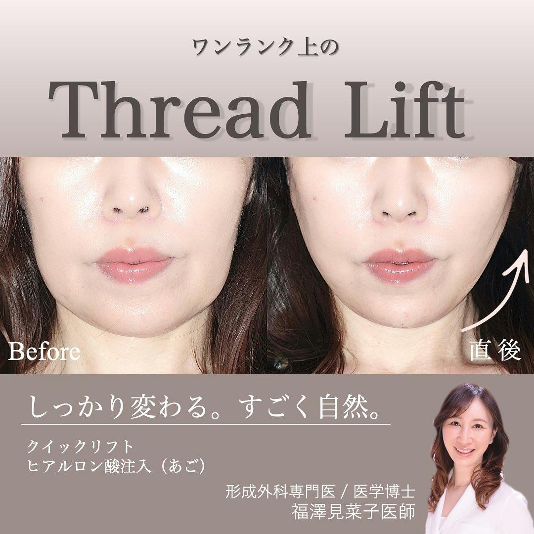 【40代後半女性・輪郭】クイックリフト、ヒアルロン酸（顎）_before_aftar