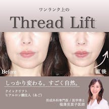 【40代後半女性・輪郭】クイックリフト、ヒアルロン酸(顎)_before_aftar