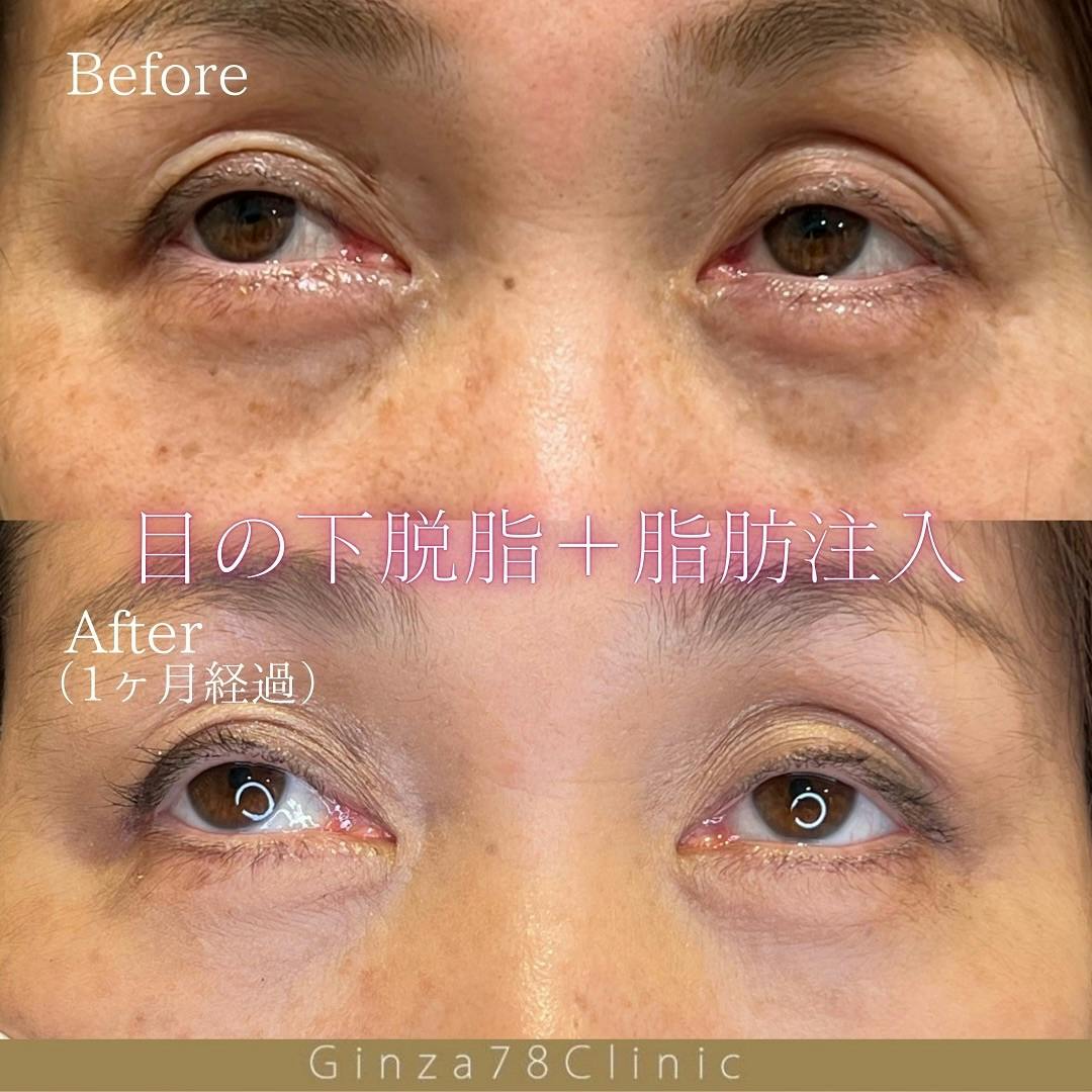 【女性・目元】目の下のクマ取り・目の下脂肪注入_before_aftar