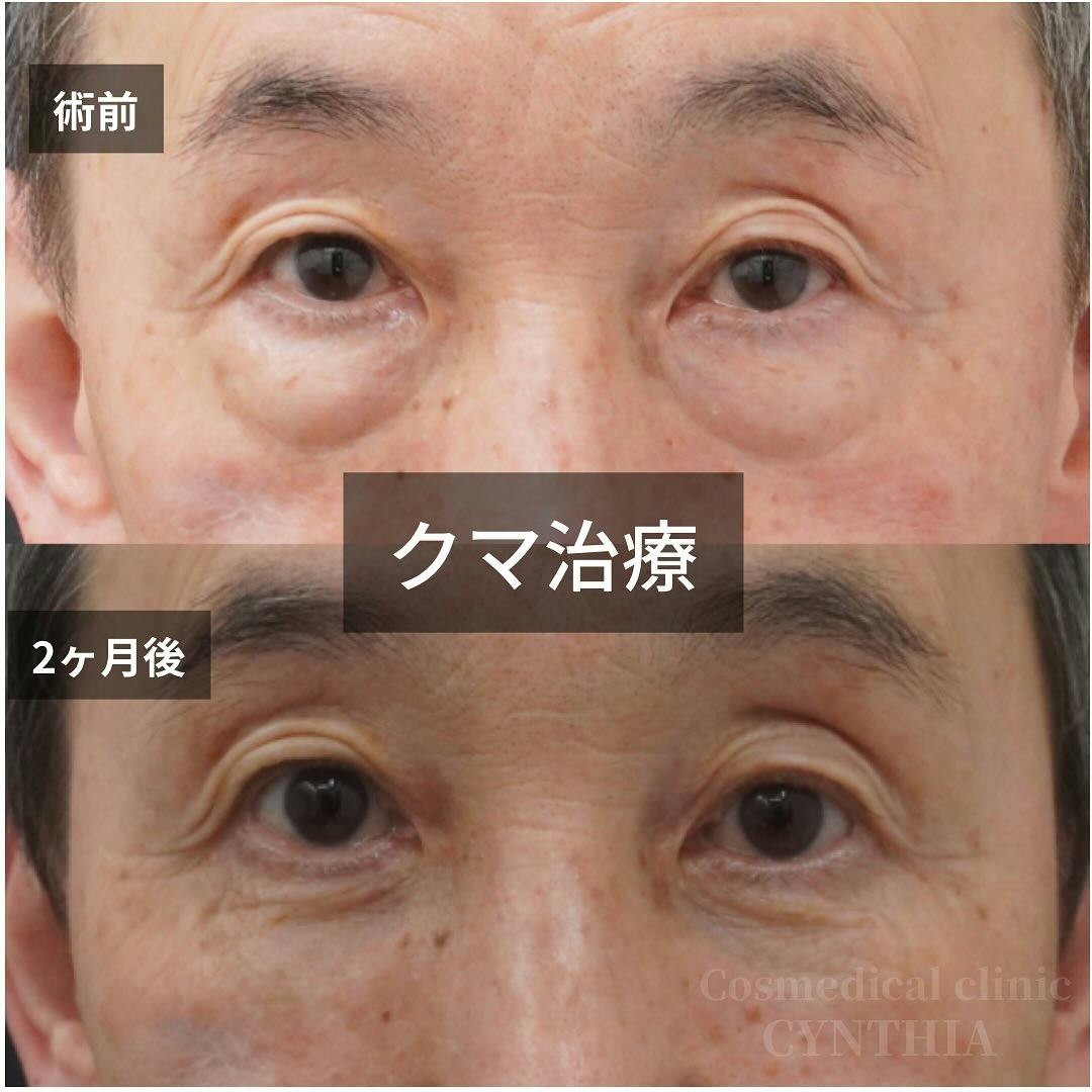 【60代男性・目元】目の下のクマ・たるみ取り_before_aftar
