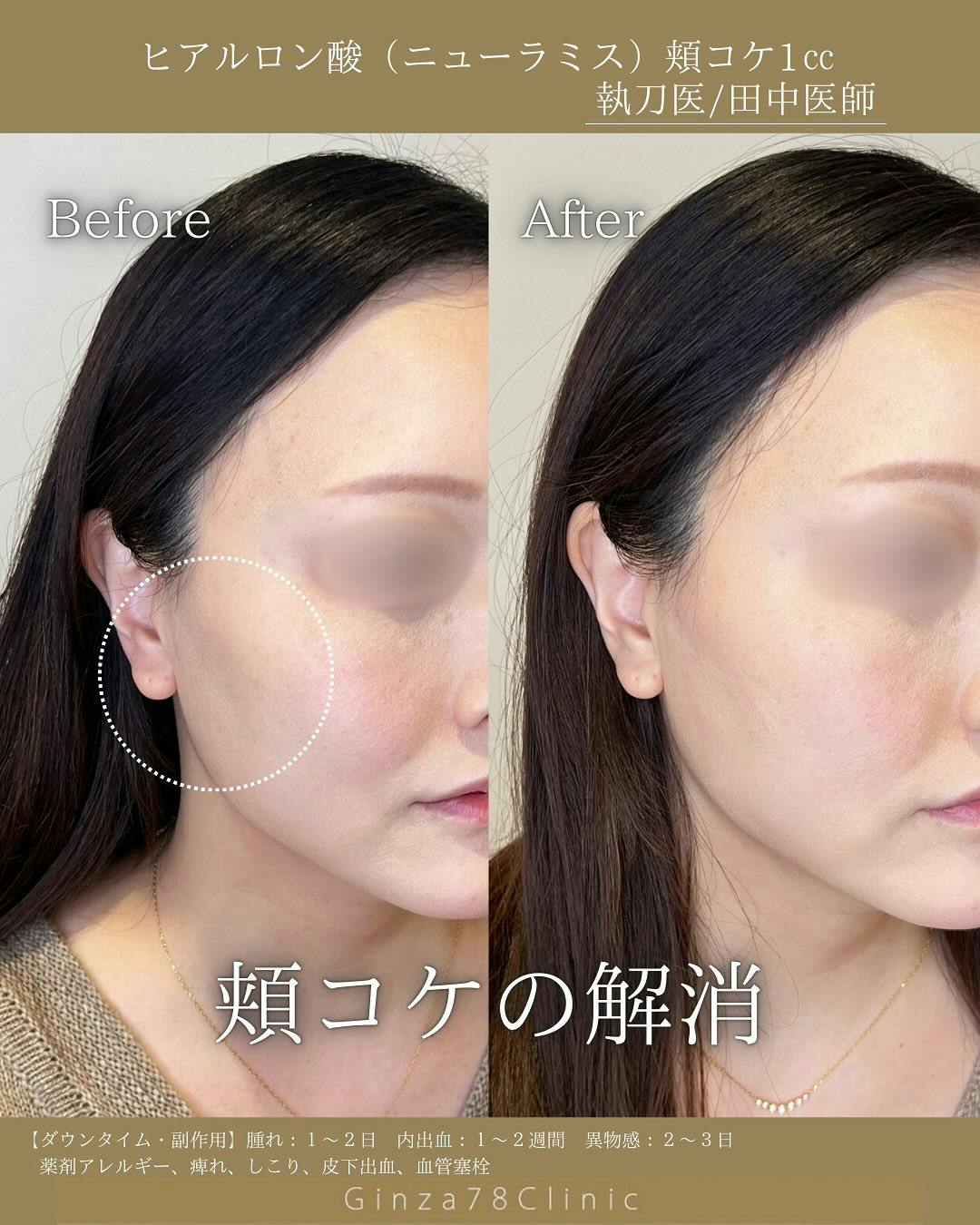 ヒアルロン酸注射・注入・ニューラミス・ジュビダーム(ヒアルロン酸