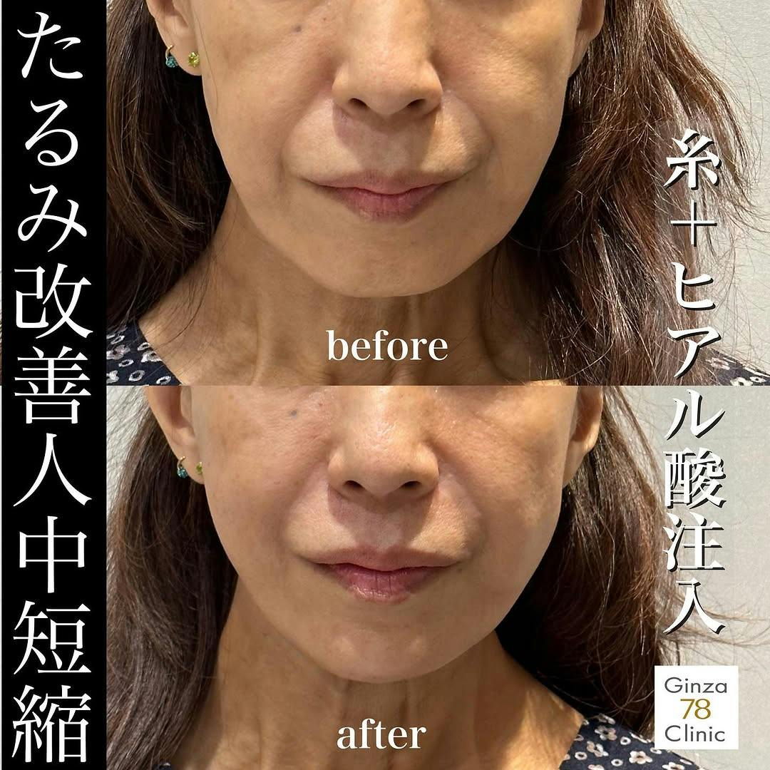 貴族ヒアルロン酸 | ニューラミス 1cc】の予約｜Ginza78Clinic(銀座