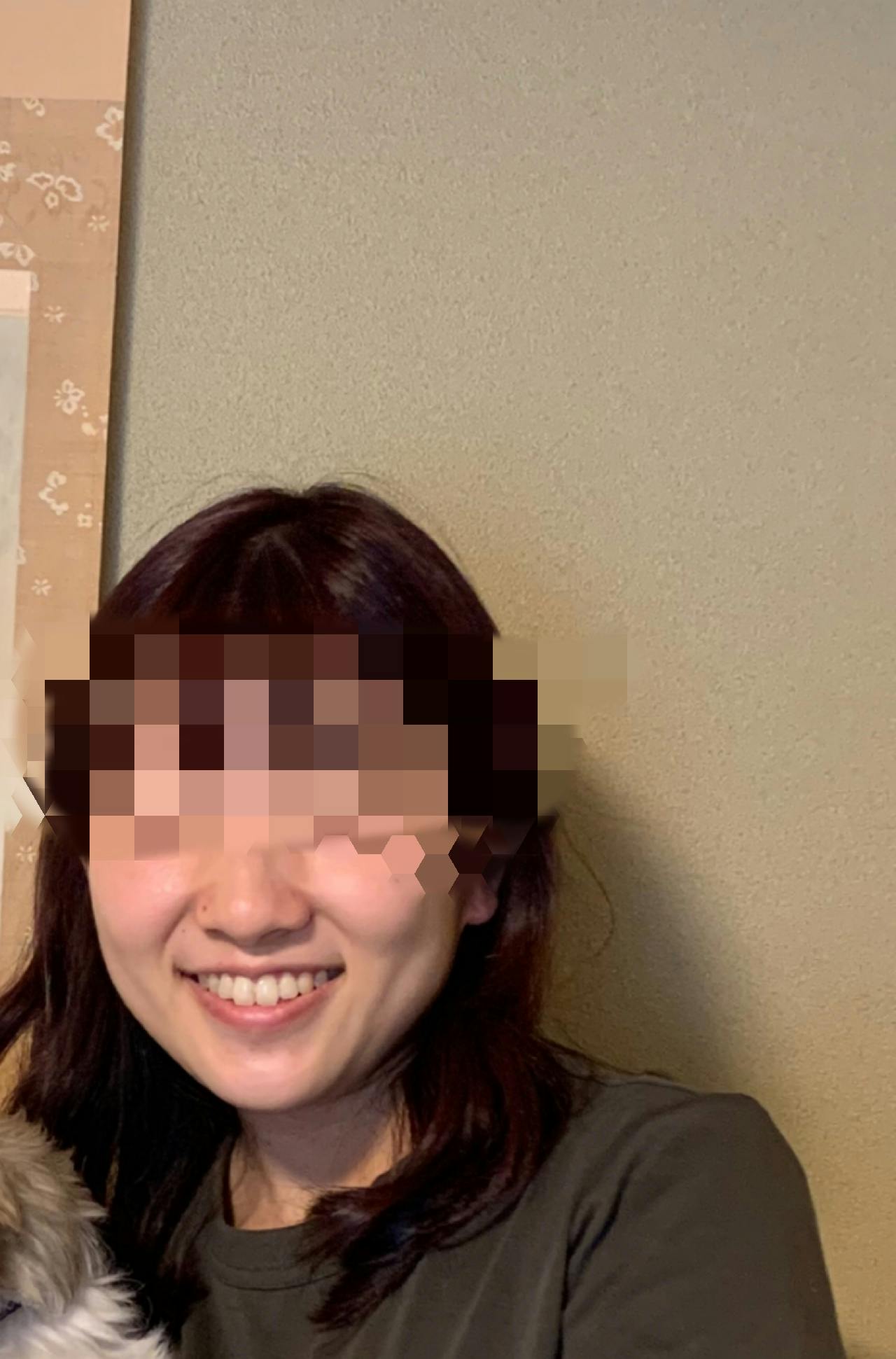 ココンベルクリニック(Cocon-Belle Clinic)でボトックス注射・エラボトックス注射(小顔)・韓国製ボトックス・ボツリヌストキシン・アラガン製ボトックス・コアトックス(CORETOX)・ボトックスビスタを受けたなすさんの写真