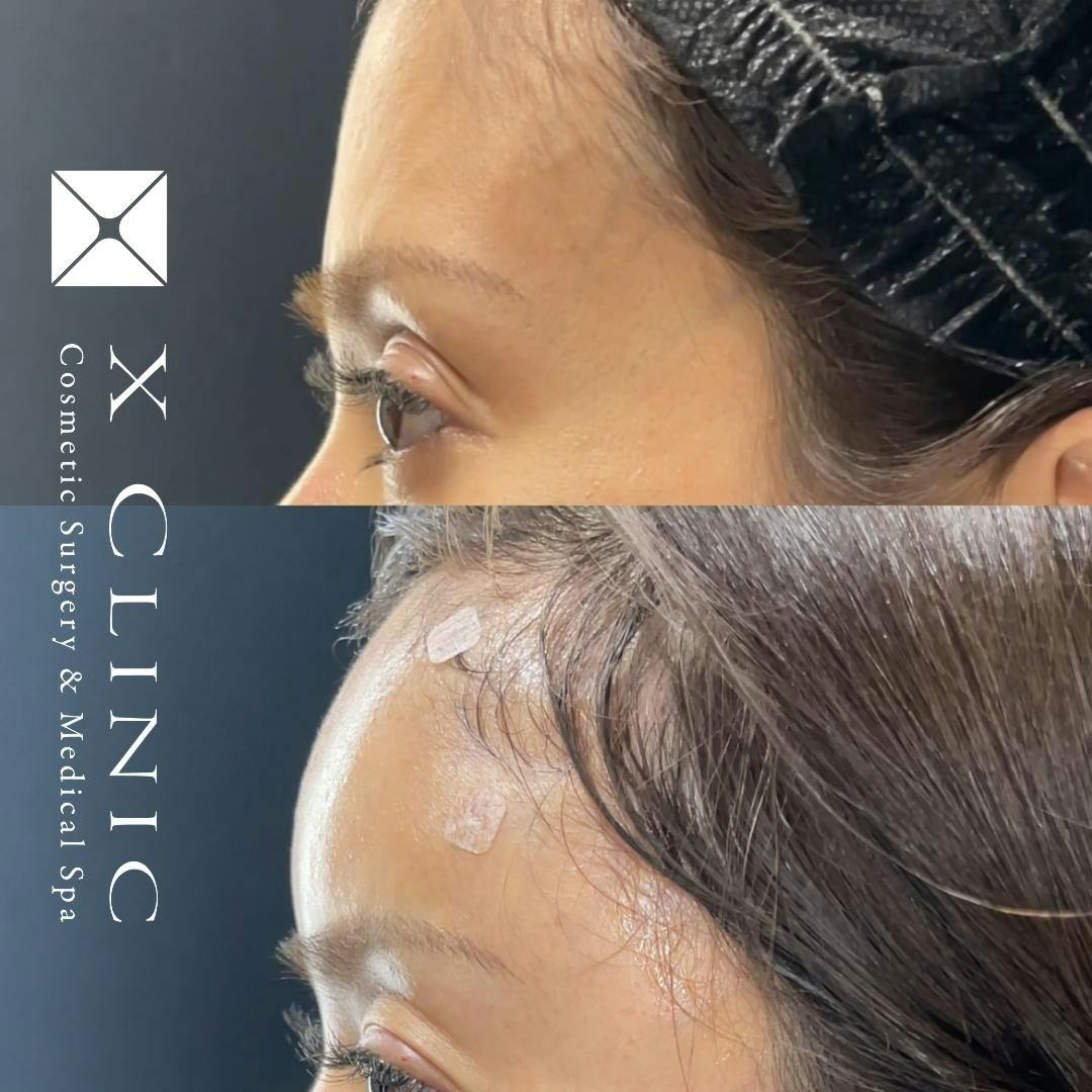 【女性・額】額こめかみ脂肪注入_before_aftar