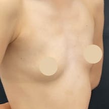 【女性・胸】Motivaエルゴノミックス2(バッグ豊胸)_before