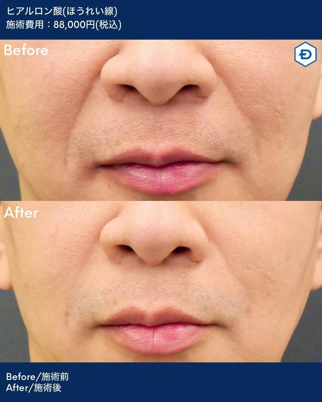 【男性・ほうれい線】ヒアルロン酸注入(ほうれい線)_before_aftar