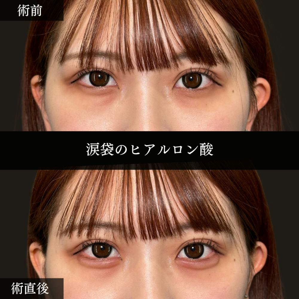 【20代女性・目】涙袋のヒアルロン酸注射_before_aftar