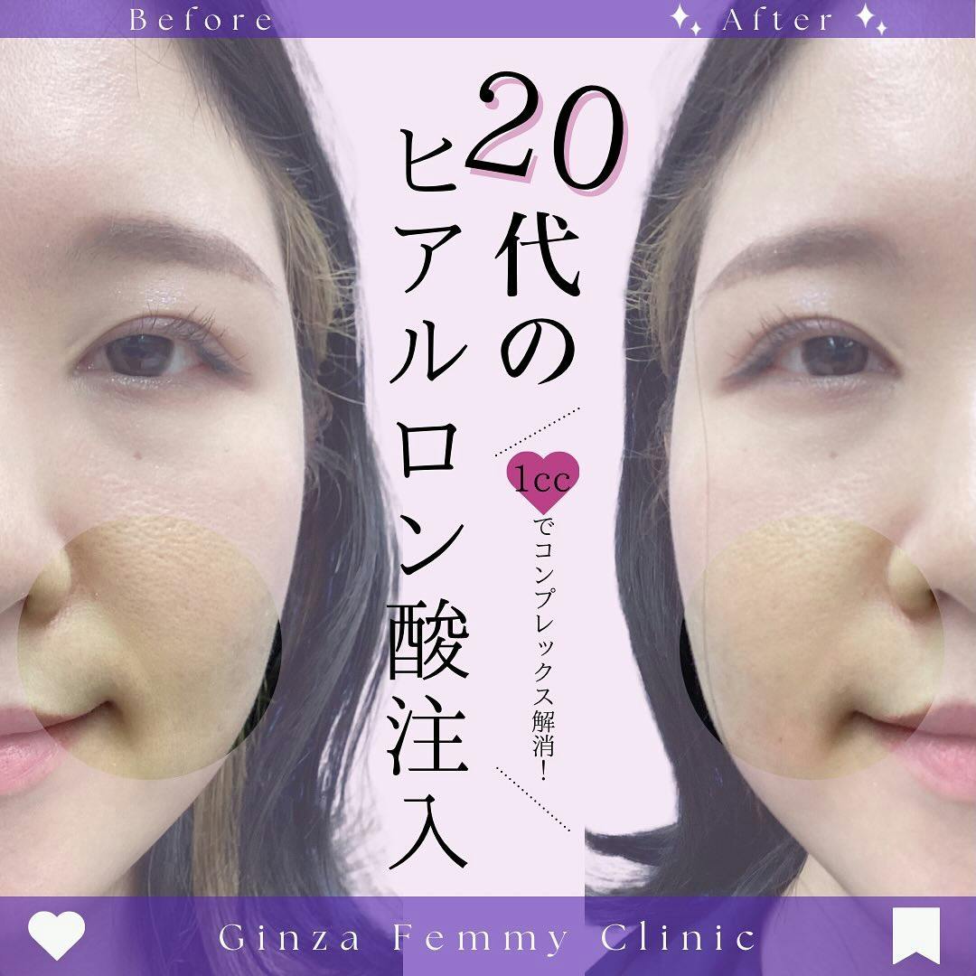 【20代女性・たるみ】ヒアルロン酸_before_aftar