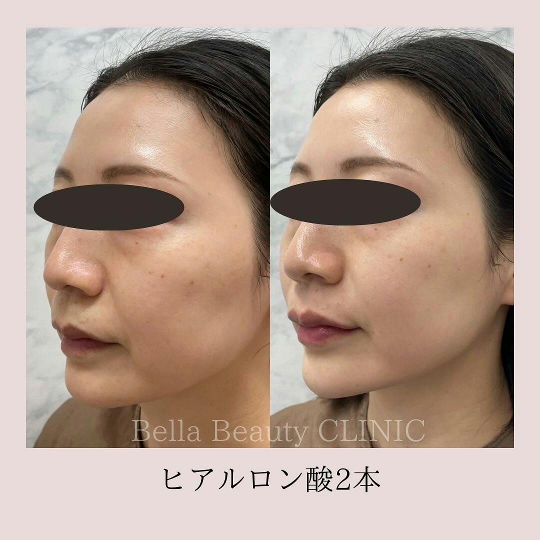 【女性・顔】アラガンヒアルロン酸_before_aftar