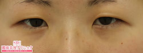 【女性・目元】クイックコスメティーク・ダブルNeo、目頭切開プレミアム、自然癒着セット（上眼瞼脱脂）_before