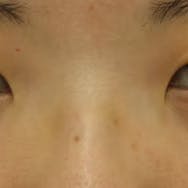 【女性・目元】クイックコスメティーク・ダブルNeo、目頭切開プレミアム、自然癒着セット(上眼瞼脱脂)_before