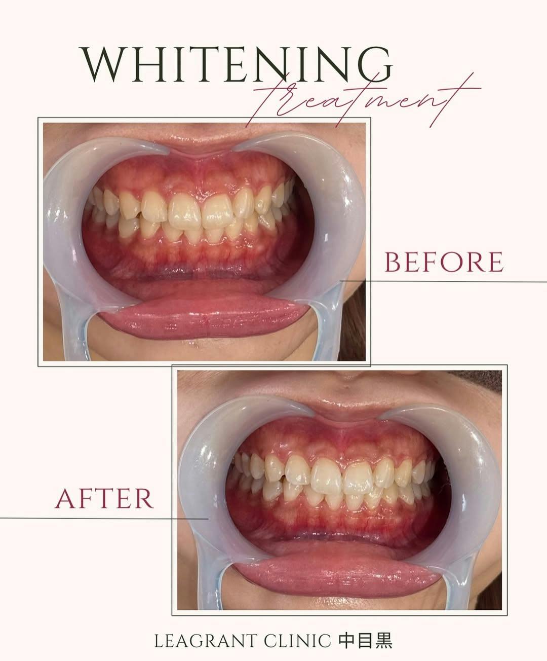 【20代女性・歯】ポリリンホワイトニング_before_aftar