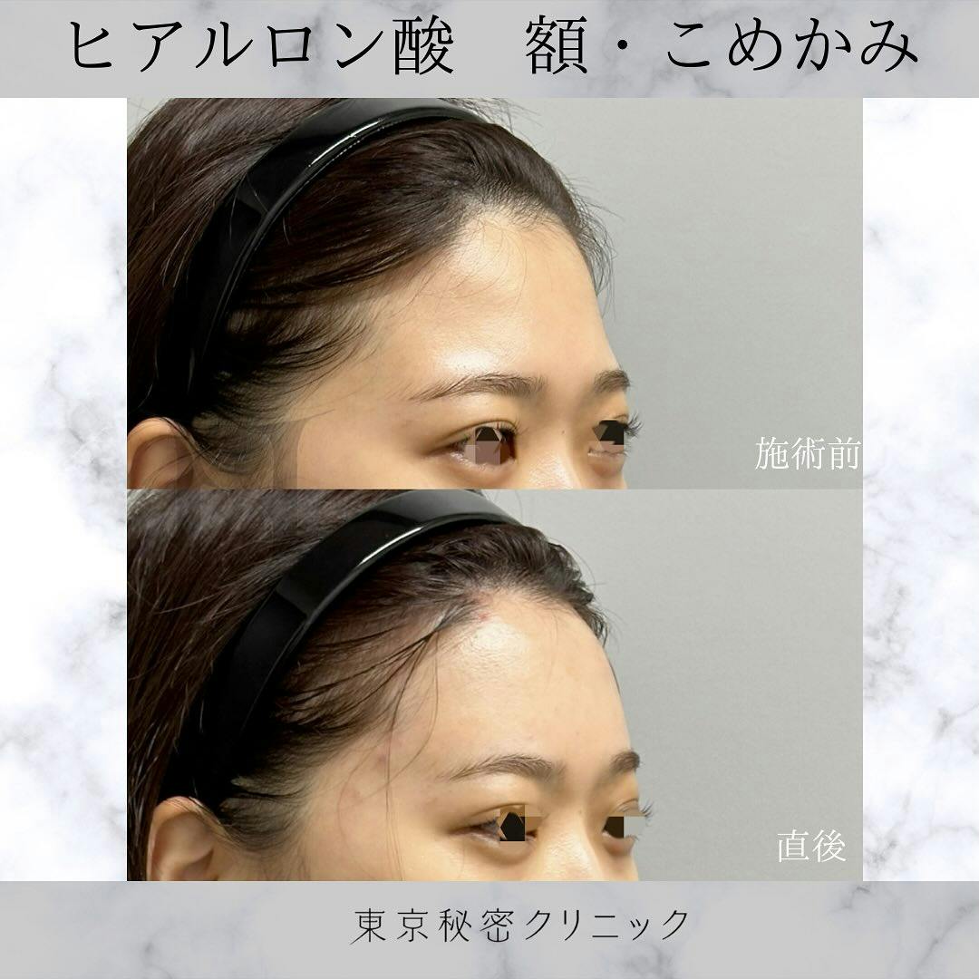 【女性・凹み】ヒアルロン酸（額・こめかみ）_before_aftar