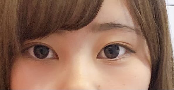 湘南美容クリニック 名古屋駅本院でクマ取りを受けたあいさんの写真