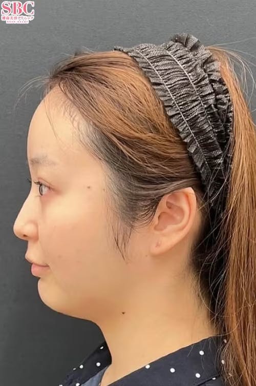 【女性・顔】Aquicell（アキーセル）脂肪吸引、根こそぎVASER脂肪吸引、糸リフト、エンブレイスRF_before